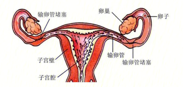哪些妇科病容易造成输卵管堵塞？